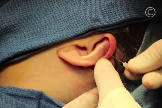 Ear Surgery