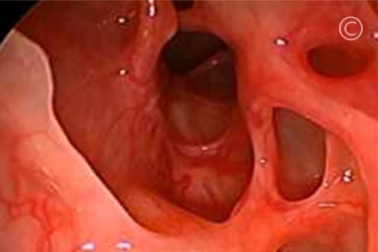Nasal and Sinus Surgery